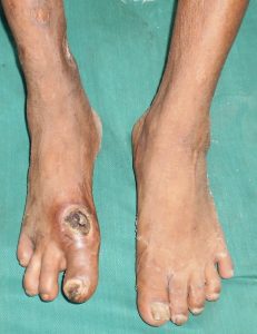 Diabetic foot infection