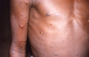 Monkeypox lesions and pustules