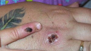 monkypox blister