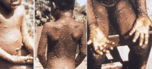 Monkeypox cases in Africa