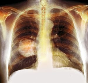 Lung cancer