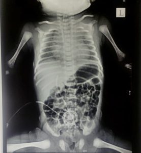 picture of the x-ray of the covid complications baby posted by the doctor on Twitter