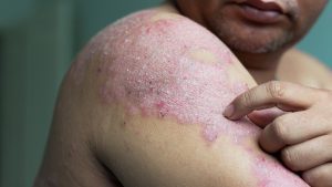 Condition of the skin, Psoriasis
