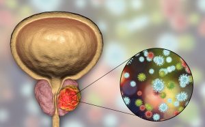 Conceptual image of prostate cancer